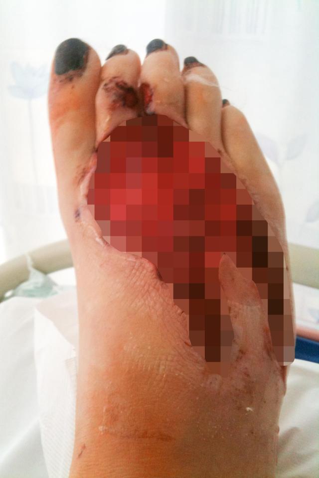 The "flesh-eating" infection left a tennis ball size hole in her right foot