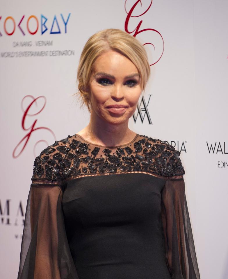 Katie was left disfigured following an acid attack in 2008