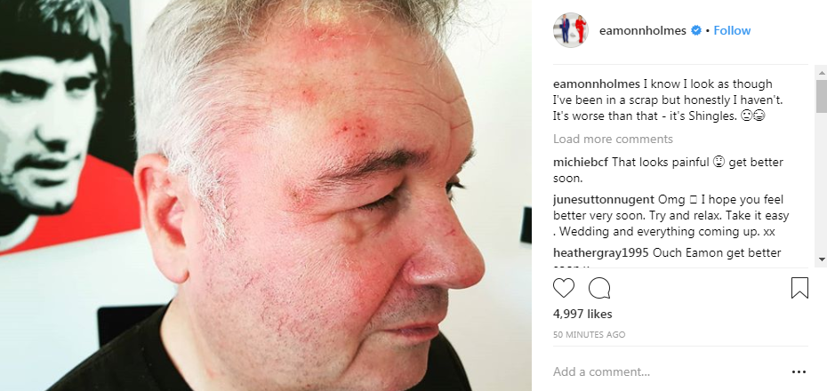  Eamonn Holmes has revealed he's contracted Shingles and showed his fans his painfully swollen face
