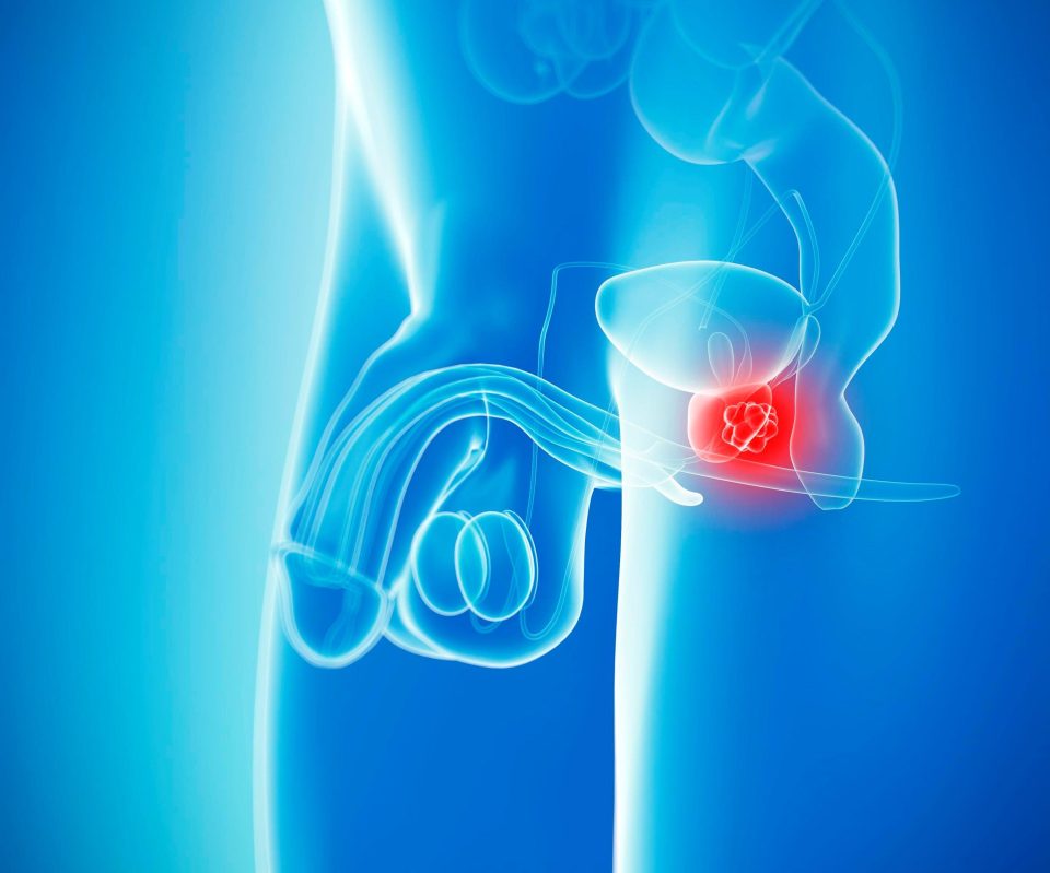 Michael was diagnosed with stage three to four aggressive prostate cancer 13 years ago - and the disease returned four times