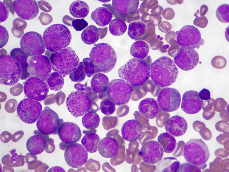  Experts have developed a new technique which picks out patterns in DNA mutation within cancers, file image of cancerous cells, and uses the information to forecast future genetic changes