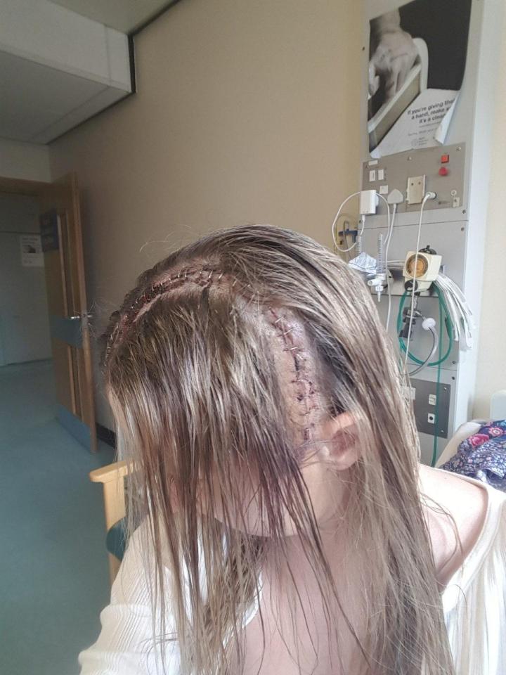  Fifteen per cent of the tumour remains