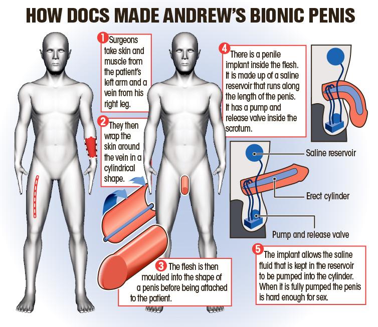  A graphic showing how Andrew's bionic willy works