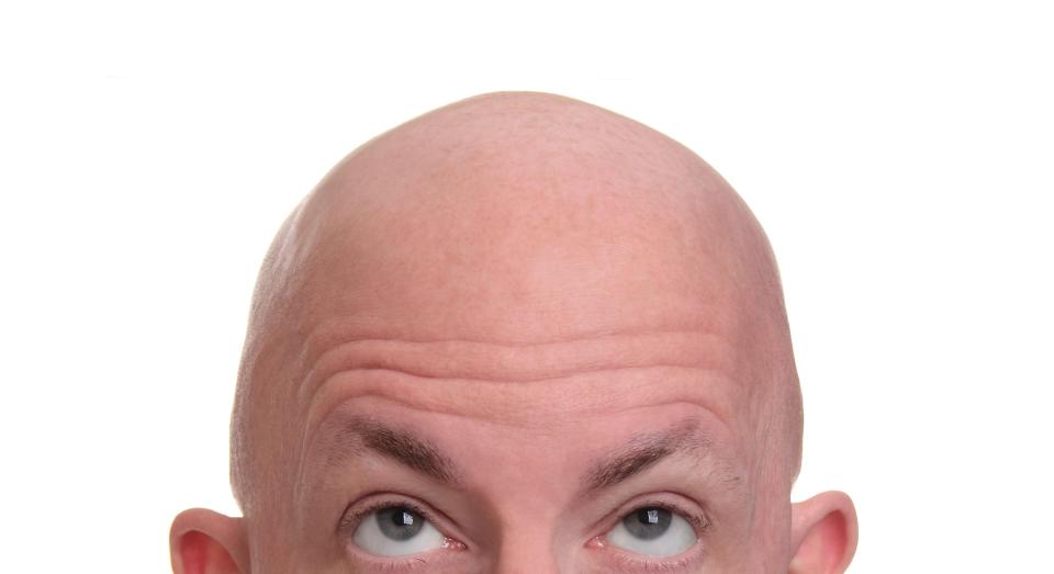 25 per cent of men start balding by the time they're 30