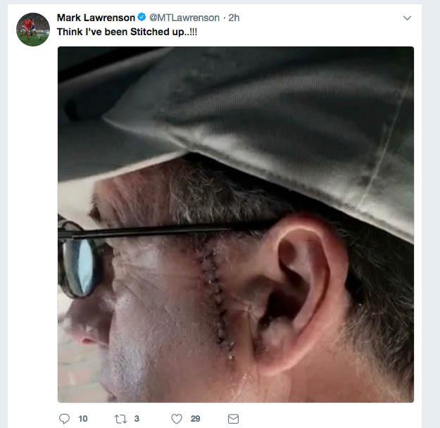  Mark Lawrenson shows the scar where he had an operation to remove a cancerous blemish
