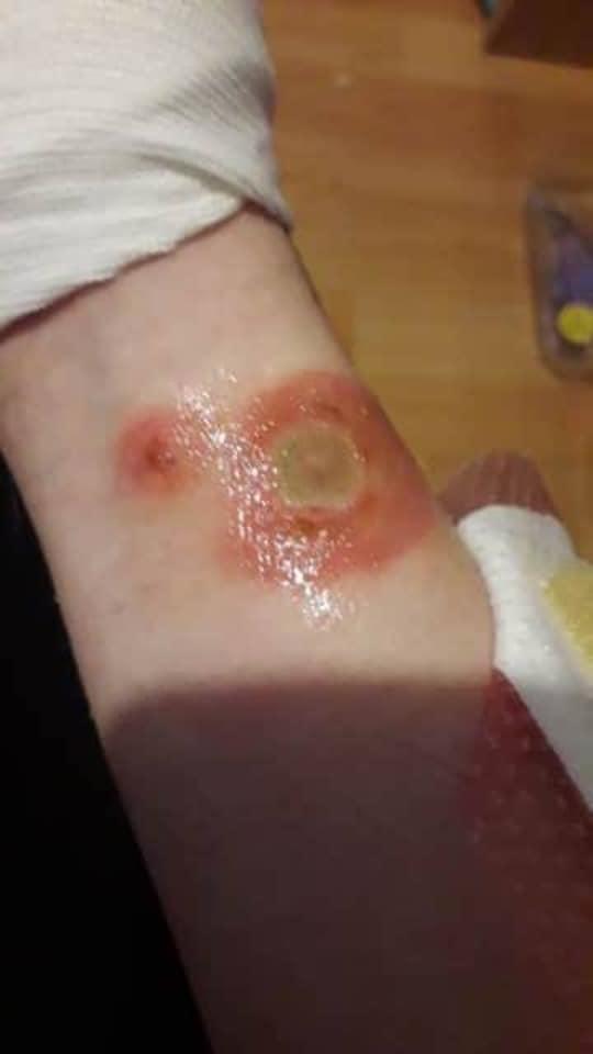 This is the burn mark 15-year-old Ellie suffered