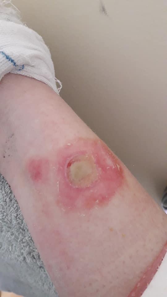 The Year 10 student was burned in May