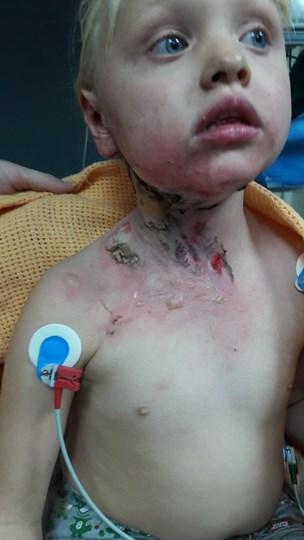  The schoolgirl's coat caught fire and Rosie-May suffered bad burns