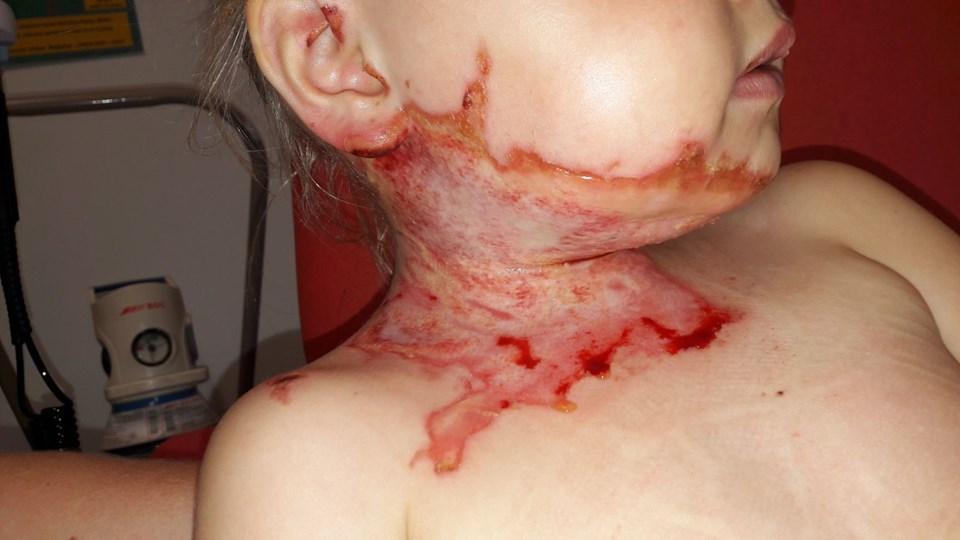  Rosie-May Mason, 4, was enjoying a fireworks display when a flare shot out and hit her on the neck