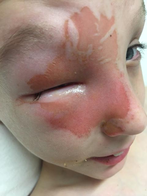  Tyler, 12, lost sight in one of his eyes after the explosion