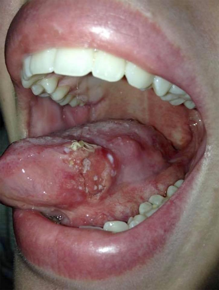 The ulcer took up a large part of Millie's tongue - and the cancer had spread to her neck