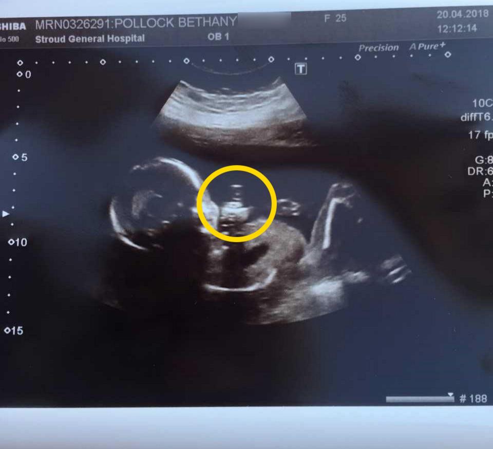  Cheeky Rudy Barnfield looked as though he 'flipped the bird' in this baby scan