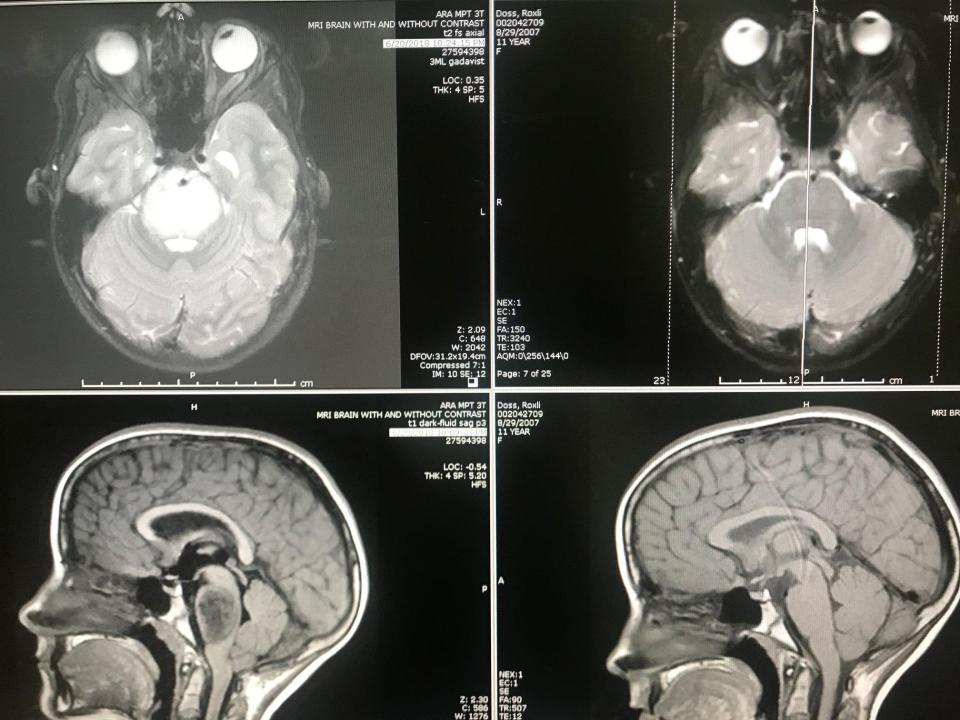  But her recent scans showed no evidence of the tumour
