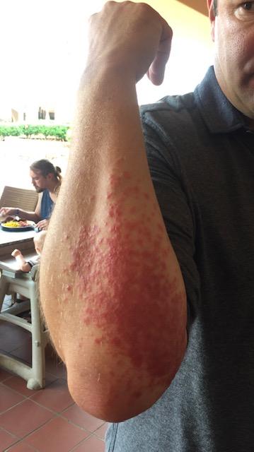 Another guest in the hotel was also badly bitten