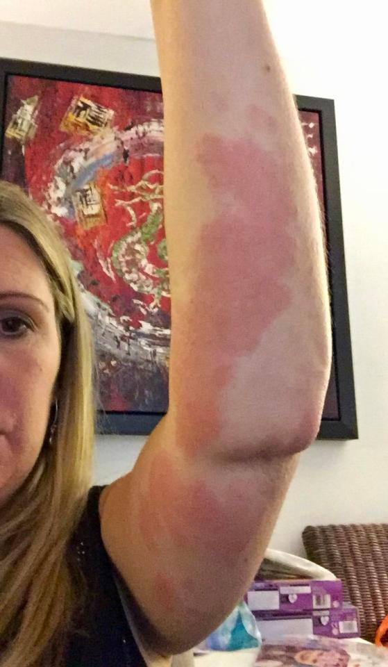 Elaine was forced to take a week off work due to the bites