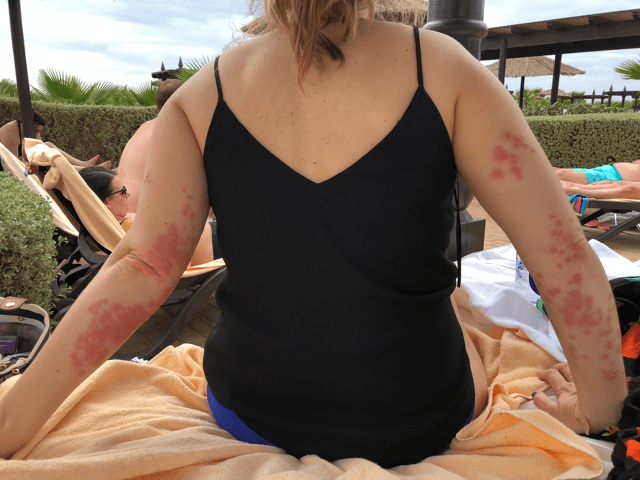  Elaine was bitten by bed bugs during her holiday to Cape Verde