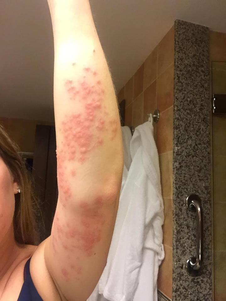 Her arms became infected from the bites