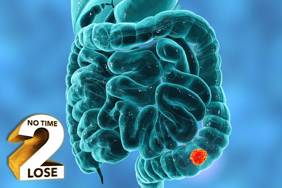  A surge in cases of bowel cancer in people under the age of 50 has prompted calls for the screening age to be lowered