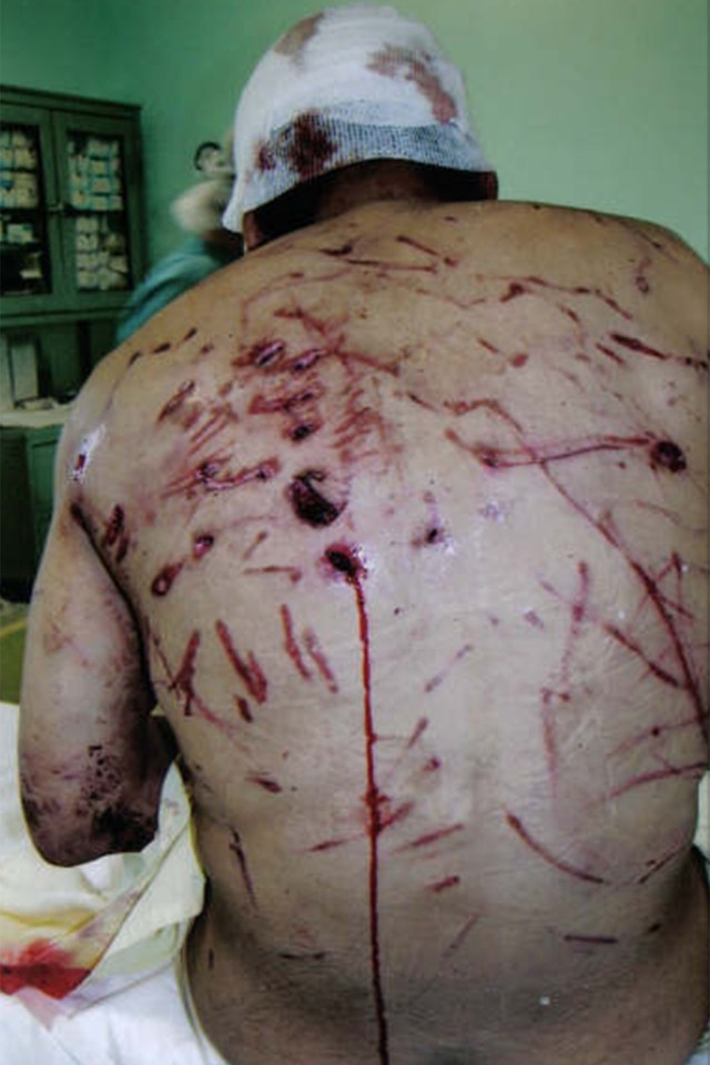  Kootoo was left with a gaping hole in his back after the attack