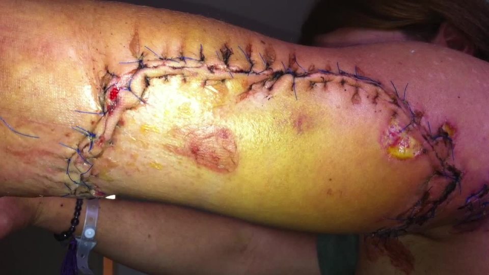  Lisa lost most of the muscle in her arm during the attack