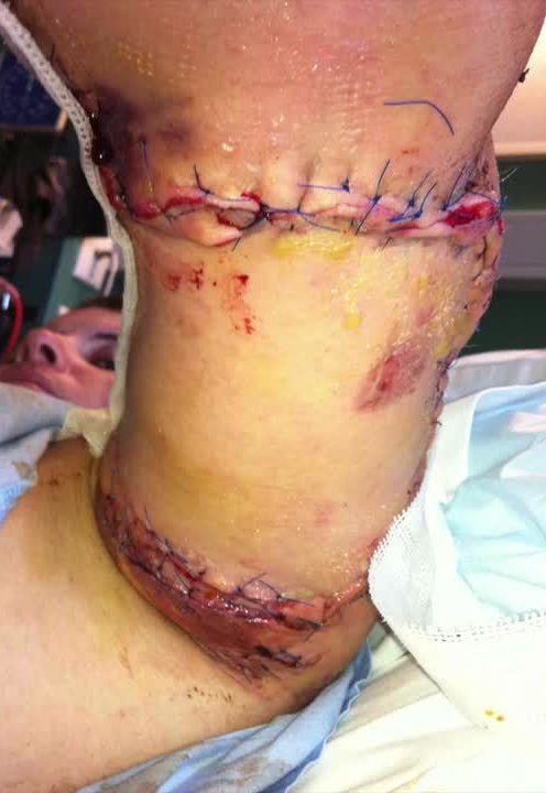  The 24 year old underwent a 16 hour surgery to save her arm