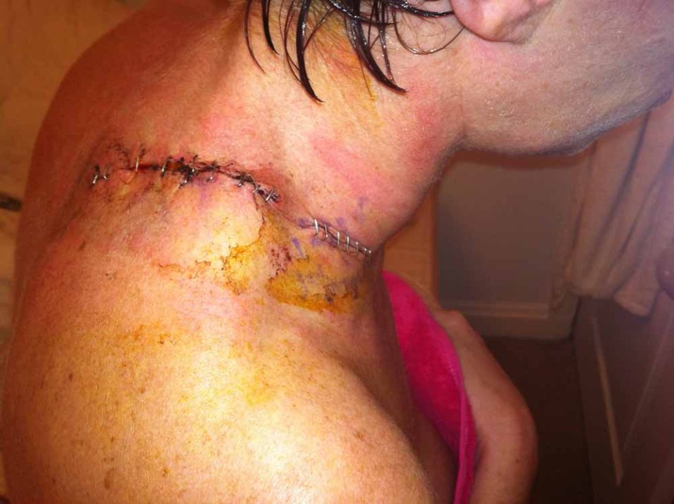  Graphic pictures show wounds caused by sunbeds