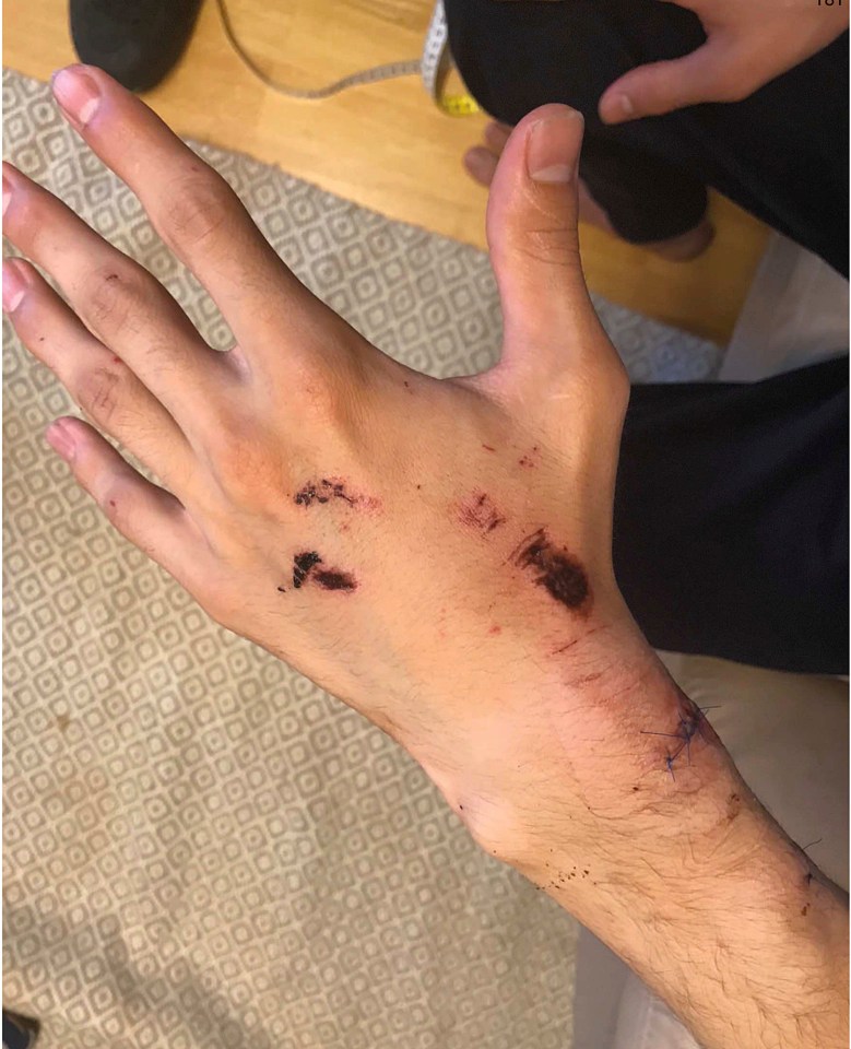  His hands bled after the altercation