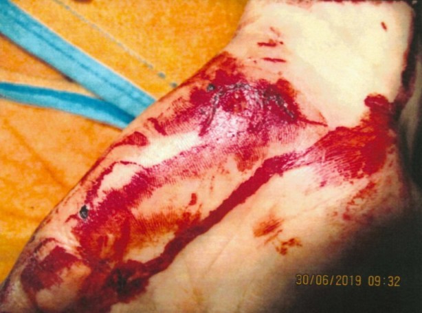 The injury sustained by alleged victim Mustafa Jafari