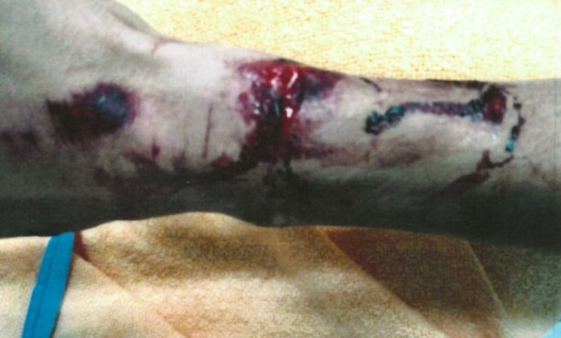  The teen's wrist sustained some injuries too