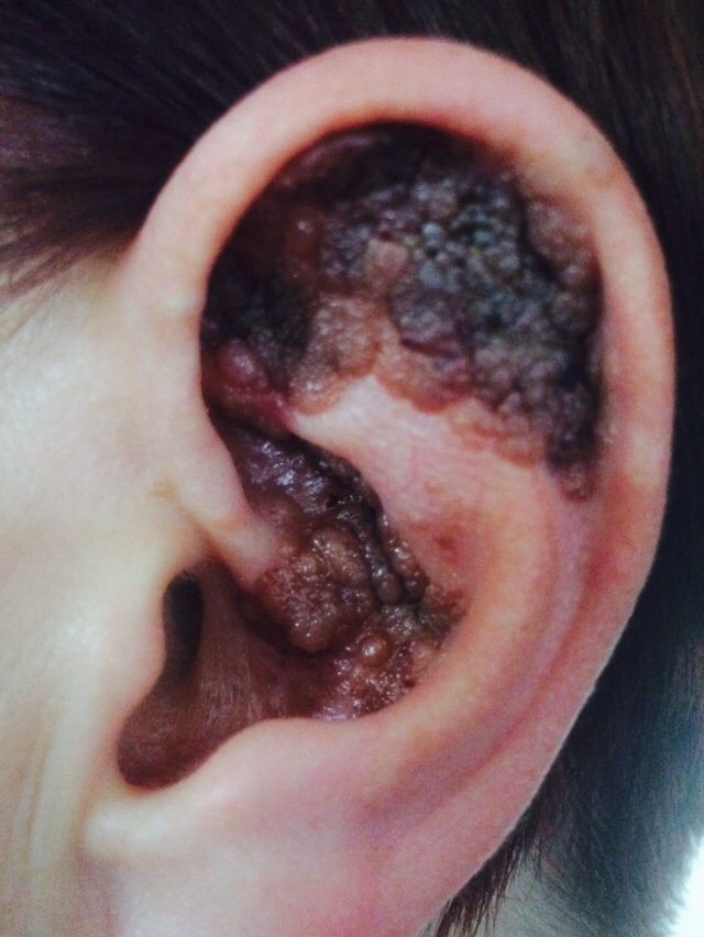  During our campaign, we will speak to women who have been faced with the horrifying effects of skin cancer