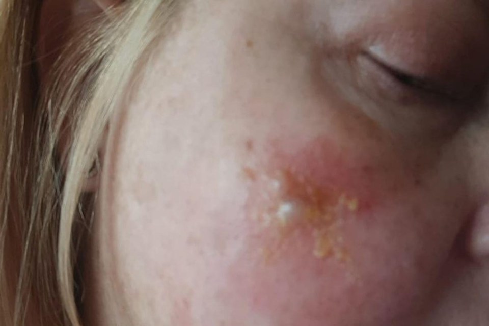 This is the blister on Sunzanne Barrister's face after he was bitten by a fly