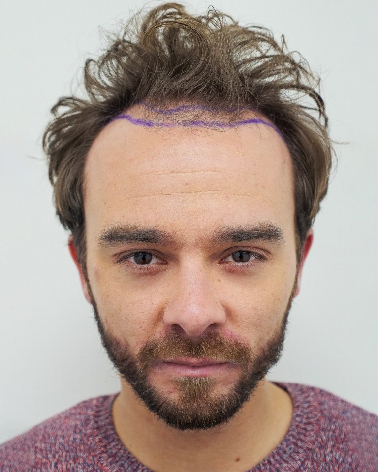  Jack has always hated his receding hairline