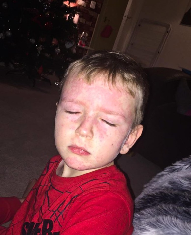  Tommy must always stay at room temperature, if he is exposed to any more or less than 20 degrees then his skin begins to break out