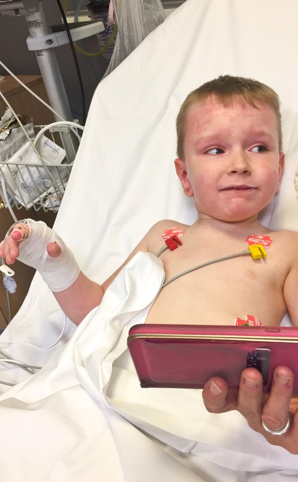  Tommy suffers with life threatening cold urticaria and angioedema