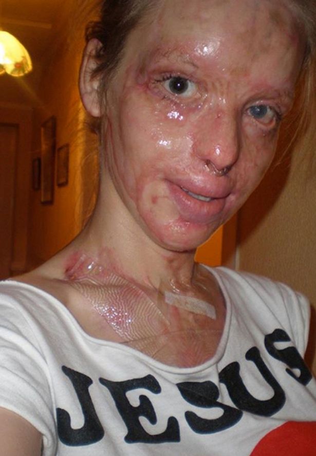  Katie was scarred for life and left blind in one eye in the cowardly attack