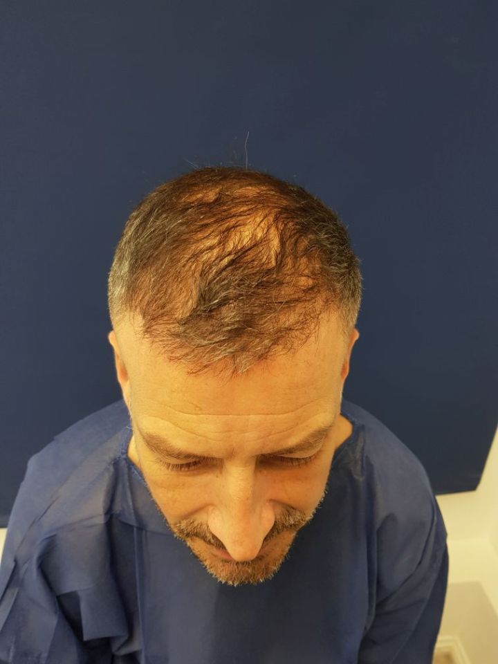  The official filled in a patch of thinning hair on his crown at the MHR Clinic