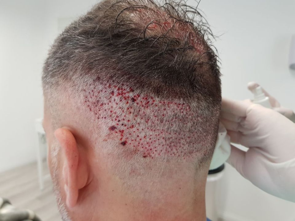  The 45-year-old is hoping to have a full head of hair once lockdown is lifted
