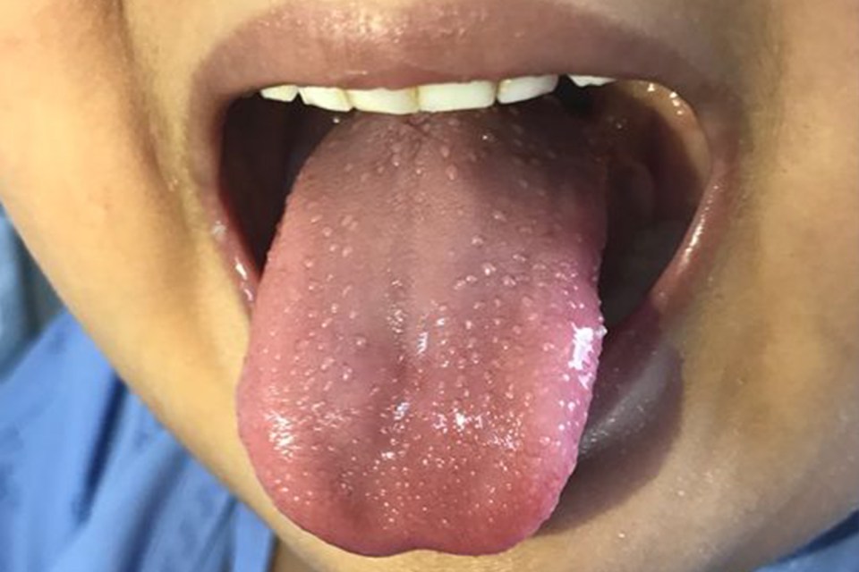  A red tongue is a symptom of Kawasaki and swollen glands is also a symptom