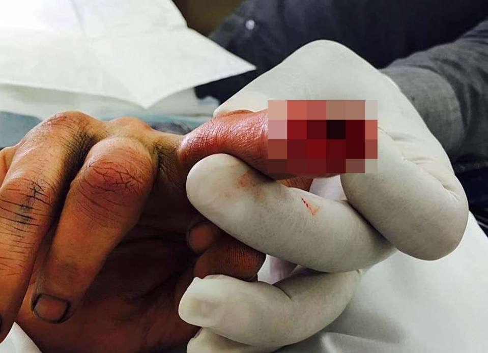 Depp severed his finger after assaulting his wife in Australia, it was claimed