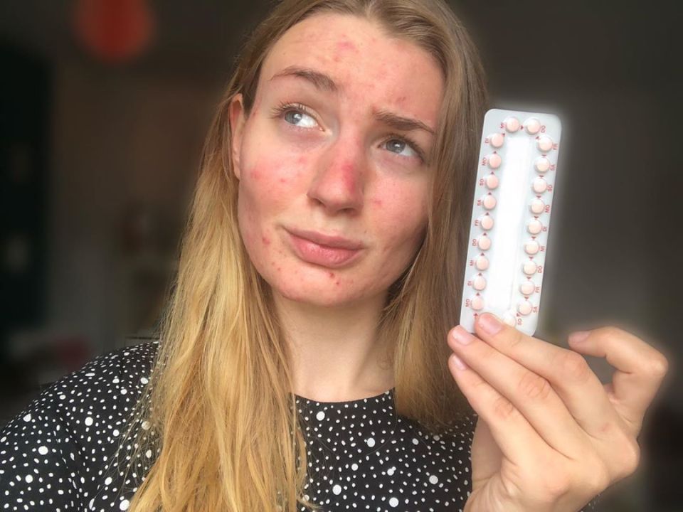 Acne had not previously been listed as a side-effect on her contraception 