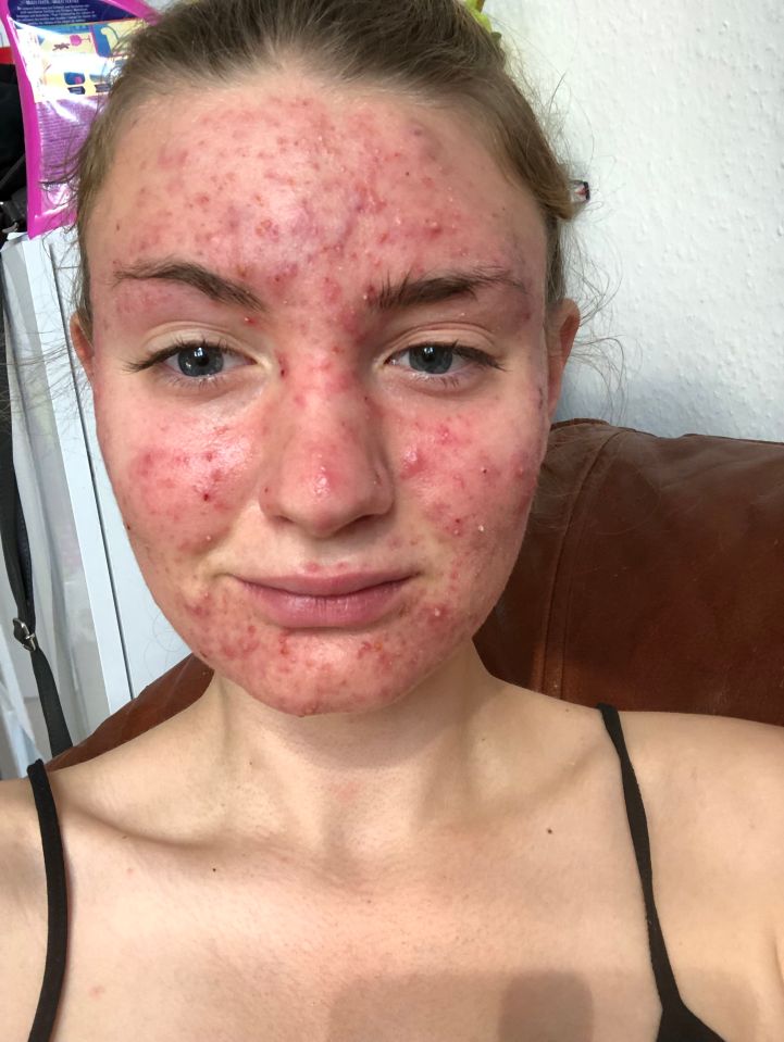 Mina Stein had never had spots but broke out in painful cystic acne after taking the pill