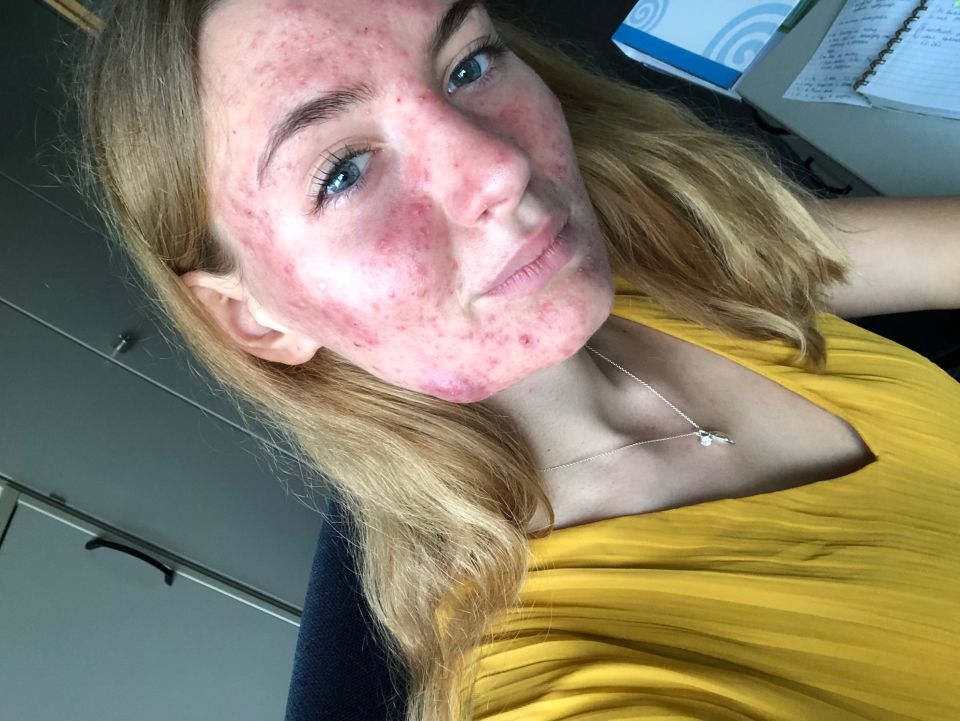 Mina now shares candid snaps of her skin to empower herself 