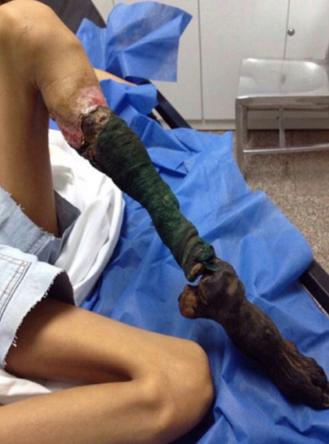 This is the shocking necrosis which ate the flesh of a teen's leg in Venezuela after she was bitten by a Bothrops viper