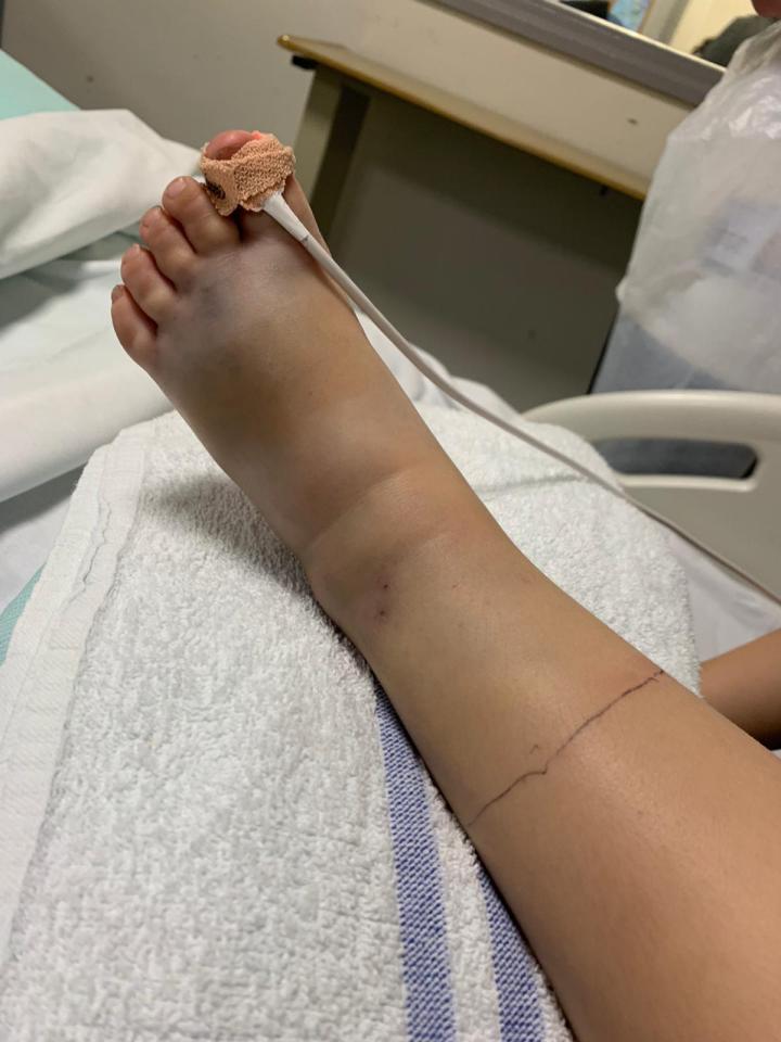 The swelling on Lewis' leg was so bad that he was left unable to walk