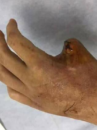 Deterioration  ultimately leaves medics no choice but to amputate