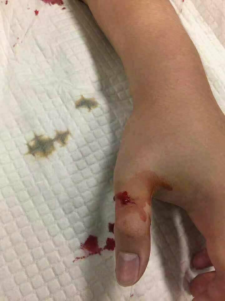 This picture was shared by US vets to show how a Sharp-nosed viper bite progresses - it begins looking like a small cut
