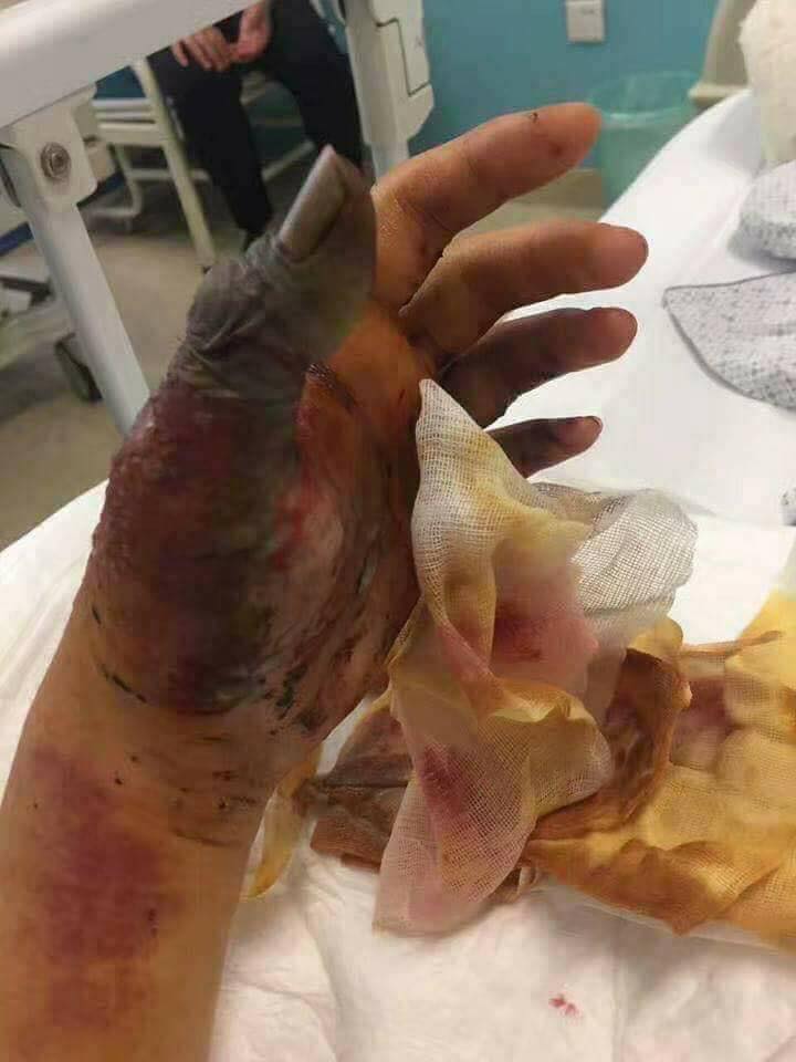 Over time, necrosis sets in as the flesh around the bite rots away