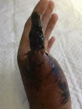 It can often result in extreme deterioration of the affected area