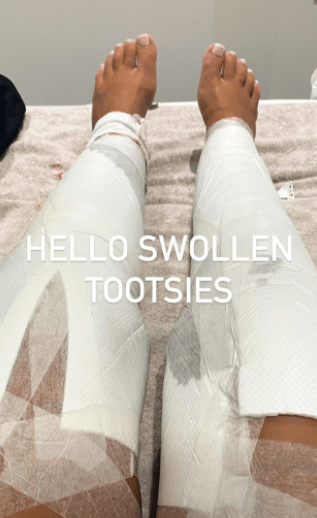 Shaughna shared a picture of her legs in casts