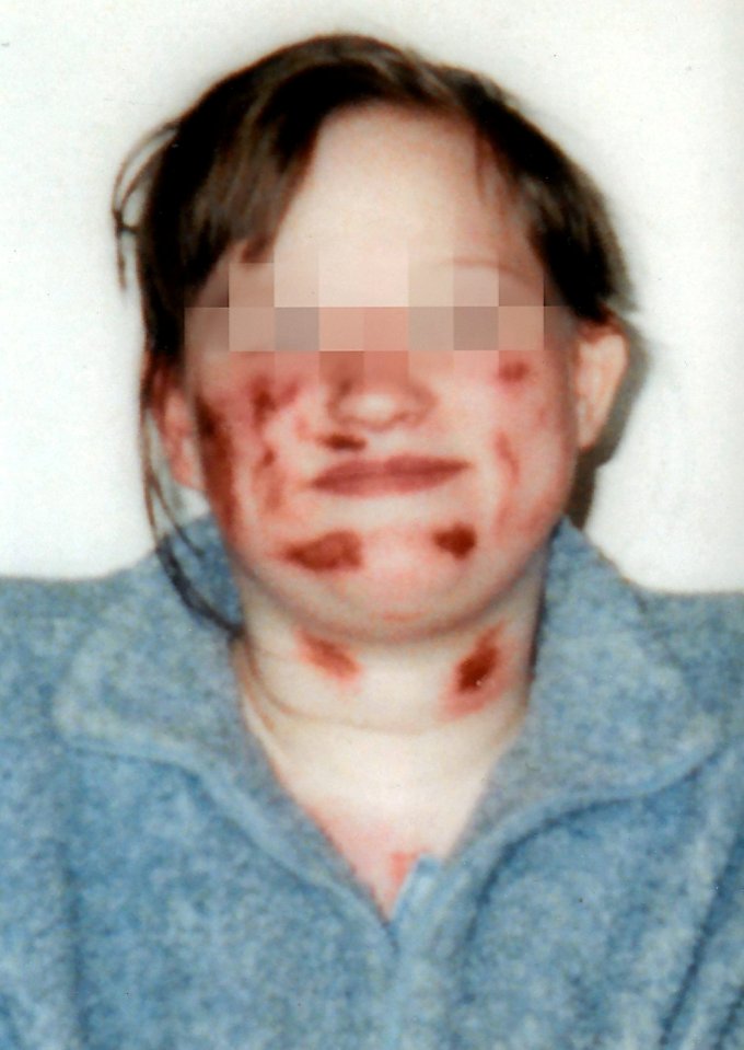 Victoria is pictured with some of her horrific injuries 